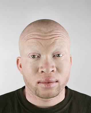 Albino Japanese Person